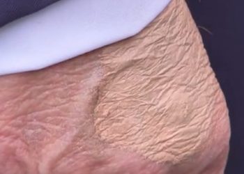 다리 붓고 손등 멍든 트럼프…백악관 “만성 정맥 부전”