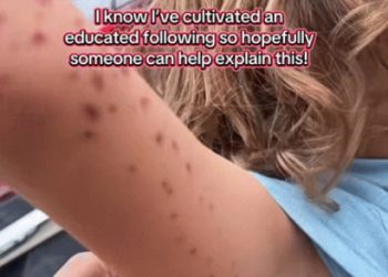 수족관 문어에 팔 잡힌 아이 … “겨드랑이까지 멍 들어”