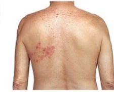 “감기 몸살인줄 알았는데 “…골든타임 72시간