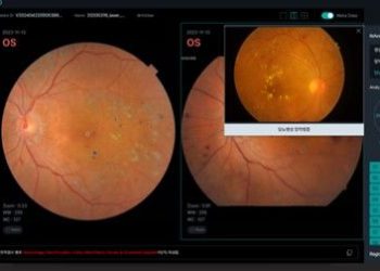 “증상 없었는데 갑자기 시력 상실”… 실명 1위 ‘이 질환’