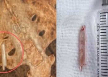 학창 시절 박힌 ‘체온계’…22년 만에 몸속에서 발견