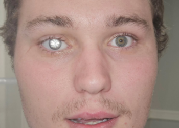 안구에 다이아몬드 삽입 … 세상에서 가장 비싼 눈 남성