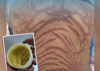 중국 연고 10년 사용했더니 … 온 몸에 뱀무늬