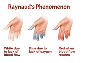 “손·발이 차가워요”…수족 냉증인 줄 알았는데 ‘이 질환’?