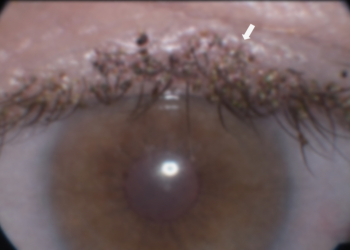 “성관계 후 이상 증상” … 눈꺼풀에서 ‘이것’ 발견