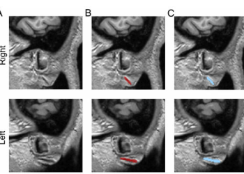 “내 귓불주름 뇌졸증 신호?”