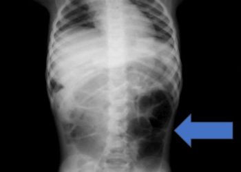 6세 아이 복통 원인은 위에 가득 찬 이것…라푼젤 증후군