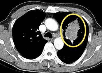 “신규 폐암 환자의 절반은 비흡연자”