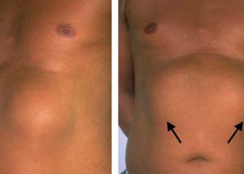 서핑 오래 하면 가슴에 생기는 혹…UC어바인 연구진, ‘리포서포마’ 규명